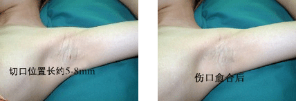 改良小切口汗腺清除术前后对比.GIF